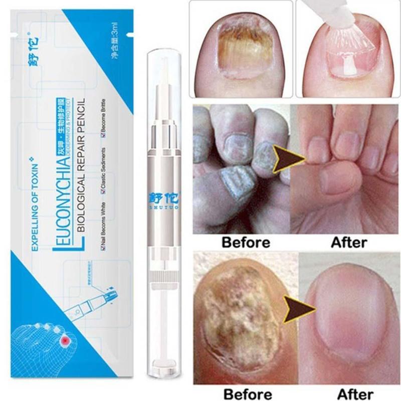 Professional Nail Fungus Treatment Pen - 3ml Biological Repair Solution